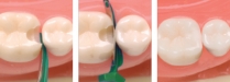 Directa, FenderMate